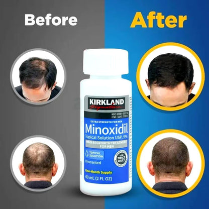 Kirkland Minoxidil 5% Topical Solution Extra Strength Hair Regrowth Treatment for Men Hair & Beard Drop with Derma Roller  (1 month supply)